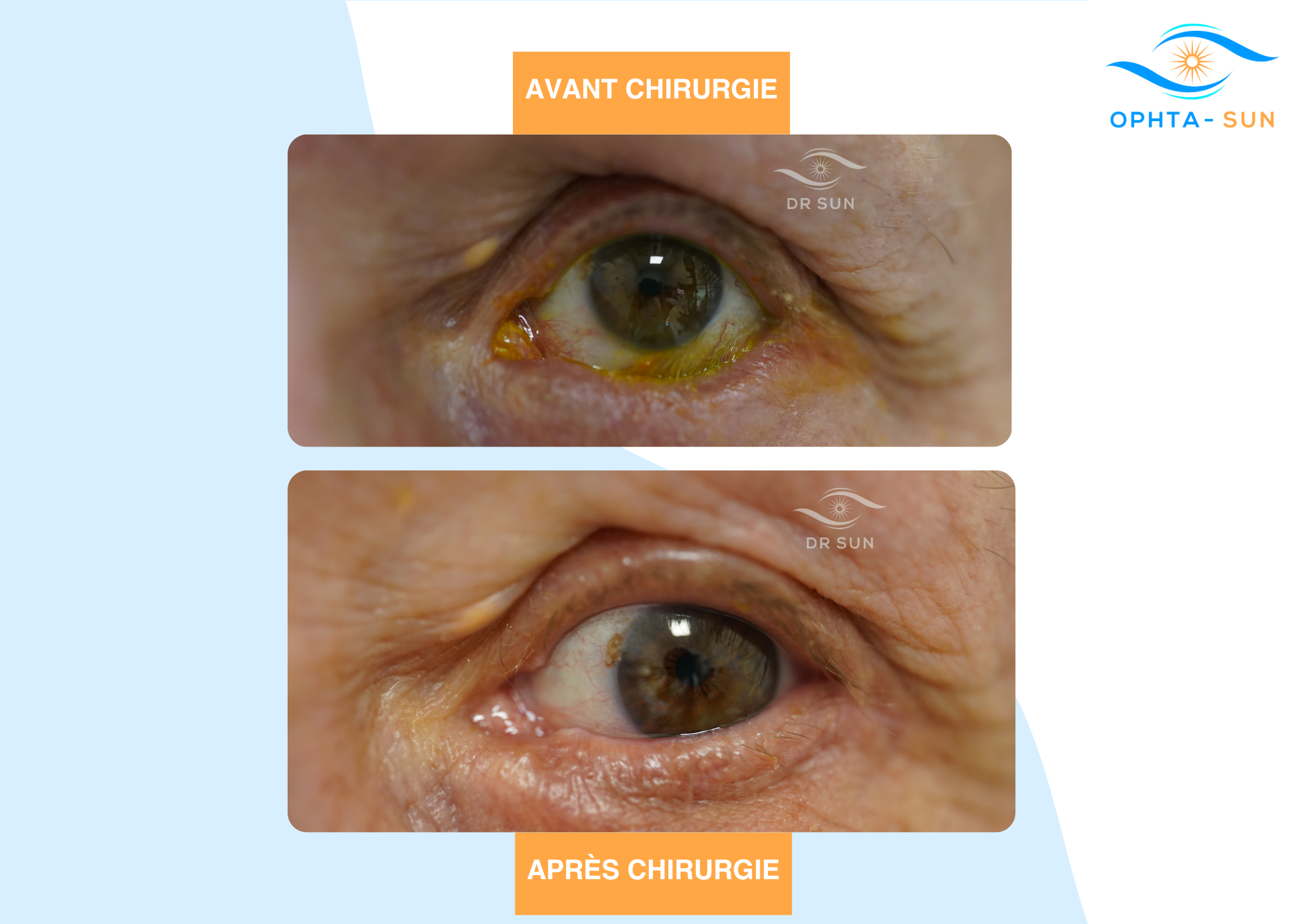 Entropion avant après